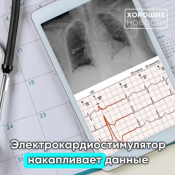 «Ростех» начал серийное производство первого российского МРТ-совместимого электрокардиостимулятора Apollo MRI