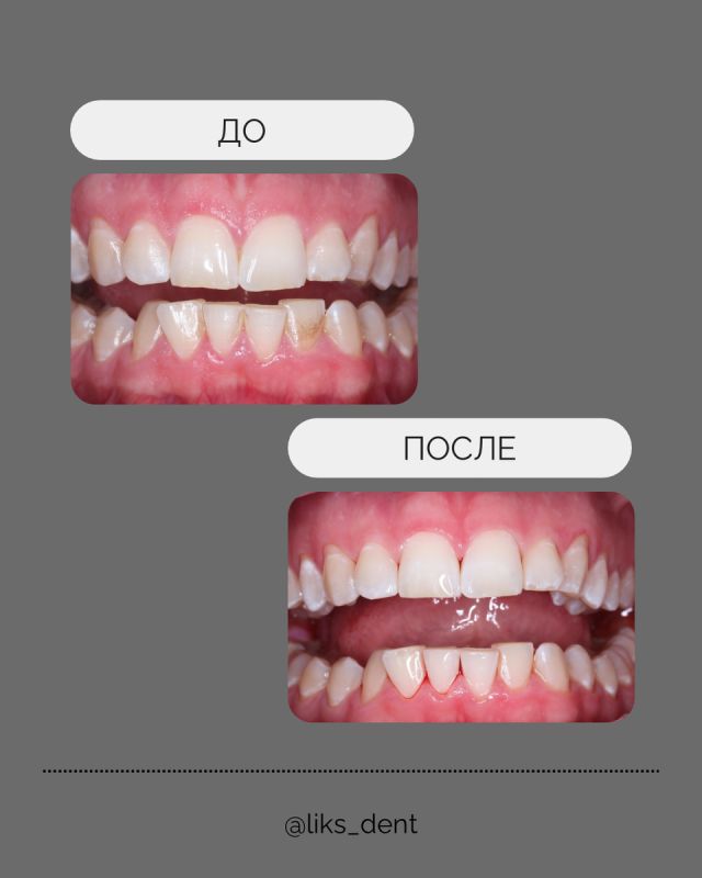 Почему стоит уделить внимание чистке зубов